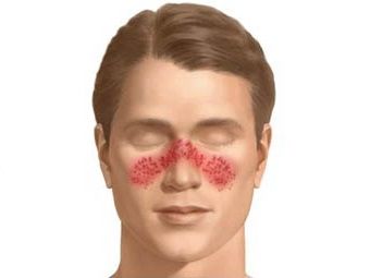systemic lupus erythematosus treatment