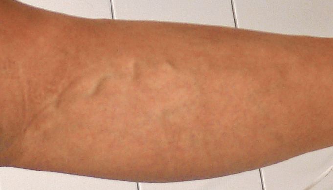consultation of a phlebologist in Moscow