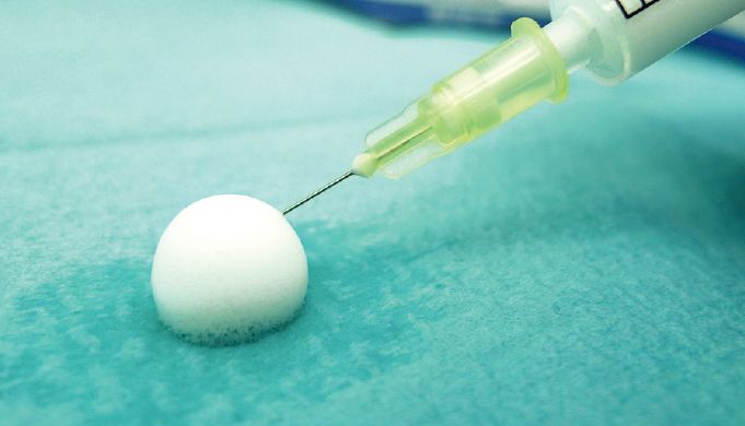 FOAM sclerotherapy under ultrasound control