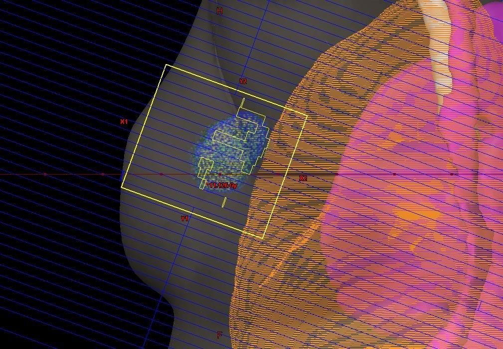 radiation therapy for breast cancer 