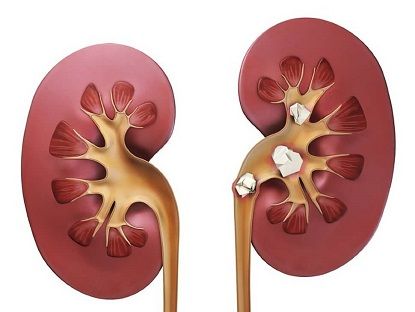 crushing kidney stones