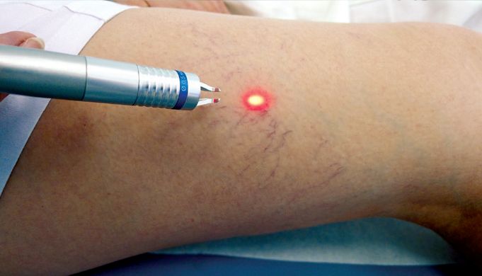 treatment of veins