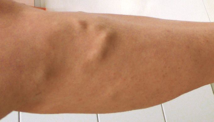 treatment of veins in moscow