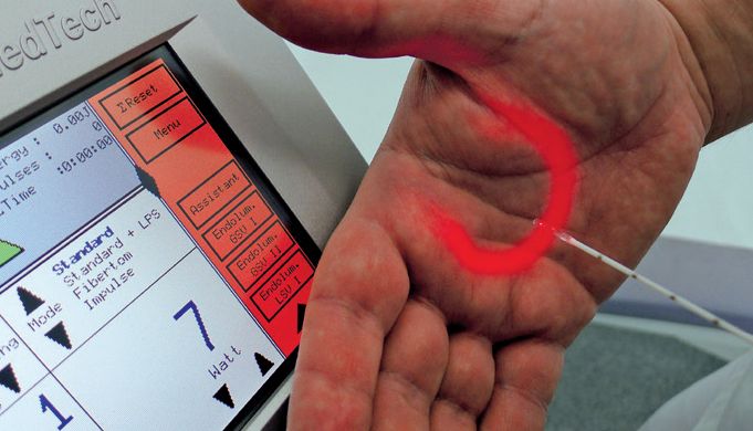 laser coagulation