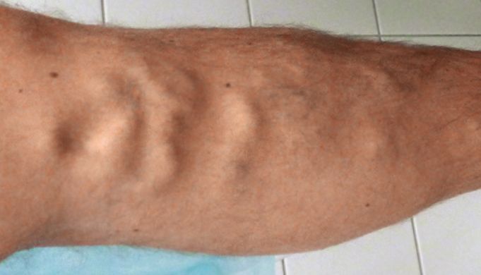 phlebologist's consultation price