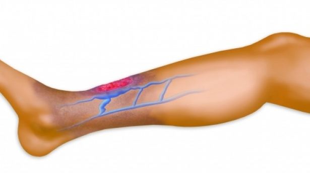diagnosis of venous thrombosis