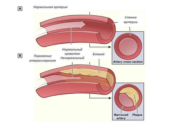 treatment of vascular atherosclerosis in Moscow