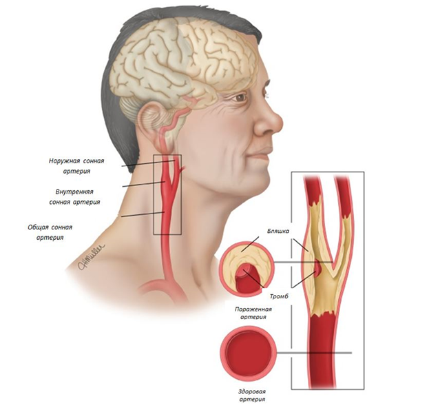 treatment of cerebral vascular atherosclerosis