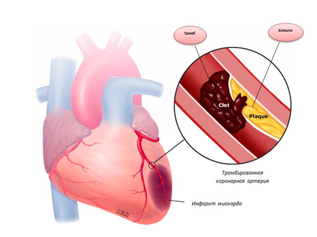 treatment of atherosclerosis of the heart vessels