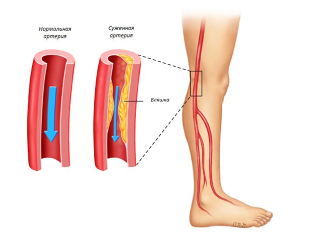 treatment of atherosclerosis of the vessels of the lower extremities