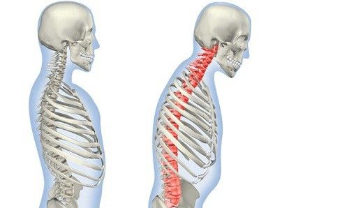 treatment of Ankylosing spondylitis, Ankylosing Spondylitis Moscow