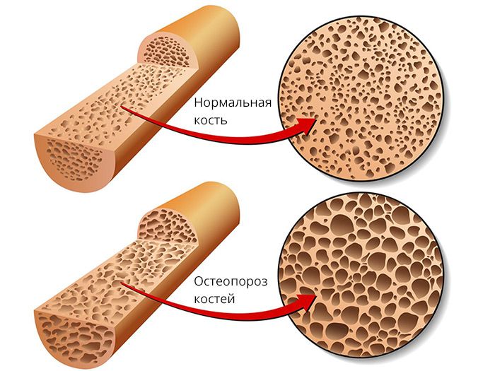 osteoporosis treatment in Moscow