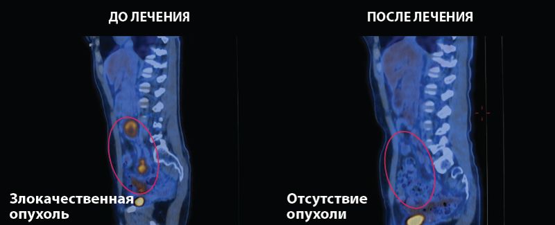 лечение рака шейки матки IV стадии