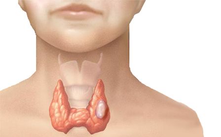 thyroid cancer treatment in Moscow