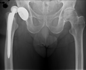 treatment of hip dysplasia