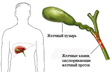 chronic cholecystitis treatment in Moscow