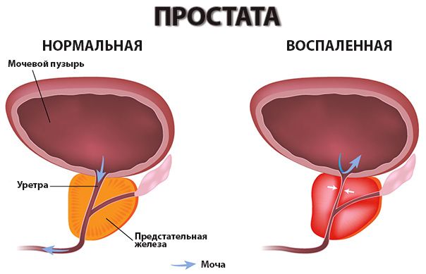 prostatitis treatment in moscow