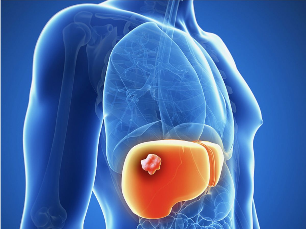 liver cancer treatment in Moscow 
