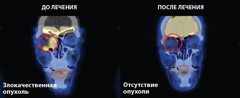 Лечение злокачественной опухоли глаза