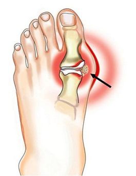 gout symptoms