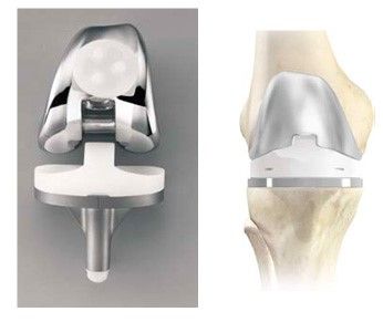 Knee replacement in Moscow