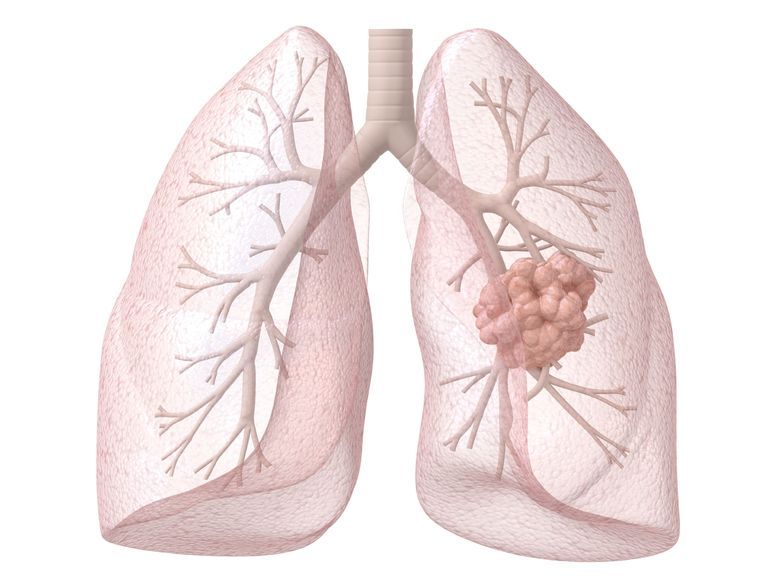 lung cancer treatment in Moscow