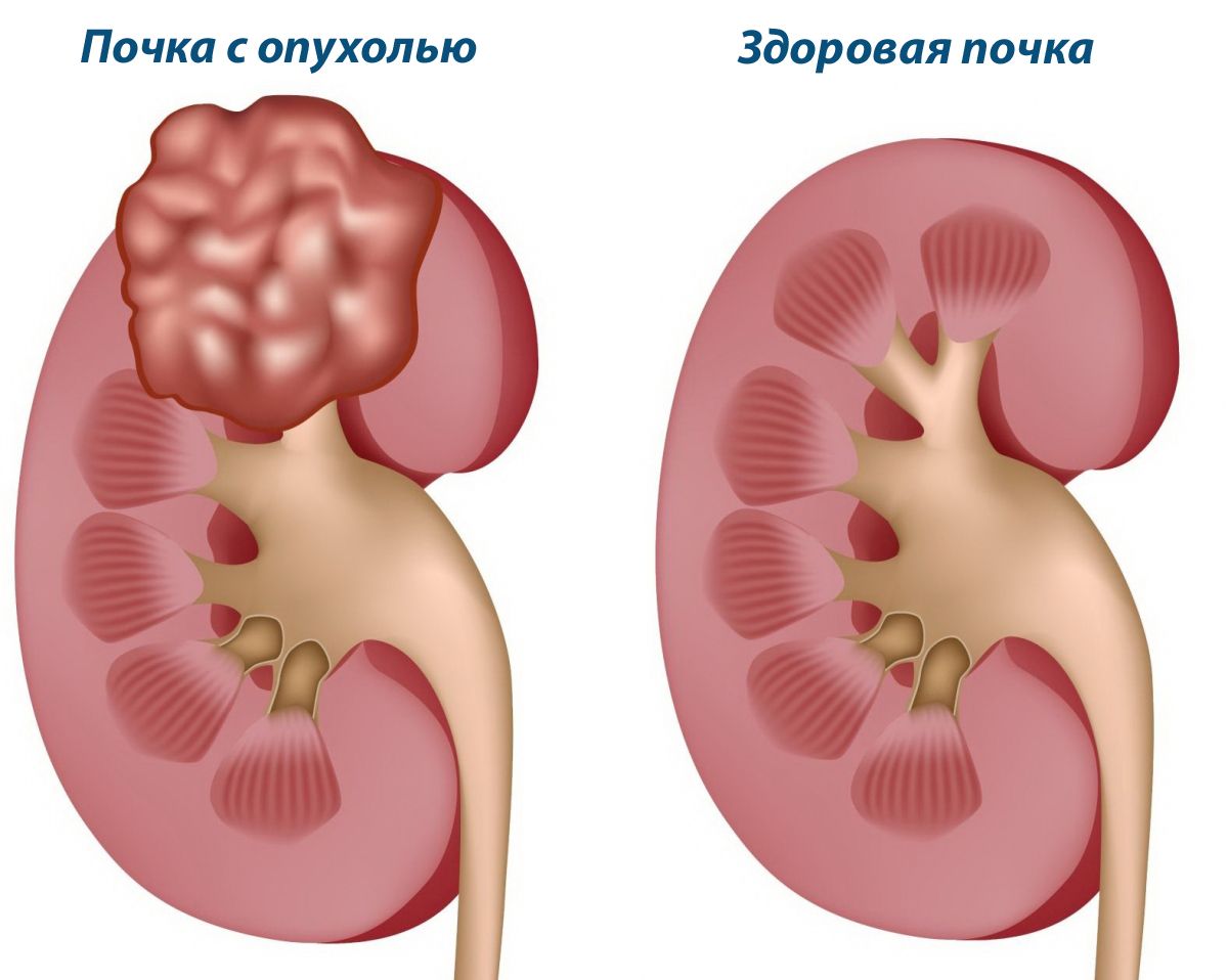 Kidney cancer