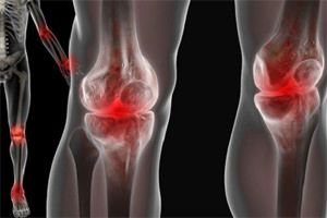 reactive arthritis treatment