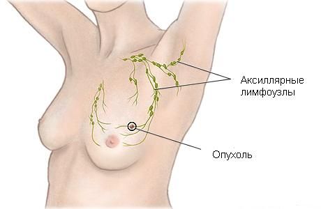 breast cancer treatment in Moscow