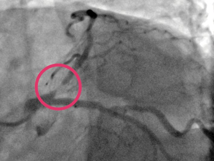 angioplasty in Moscow