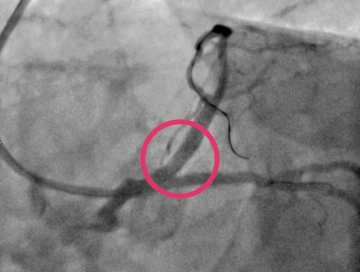vascular angioplasty