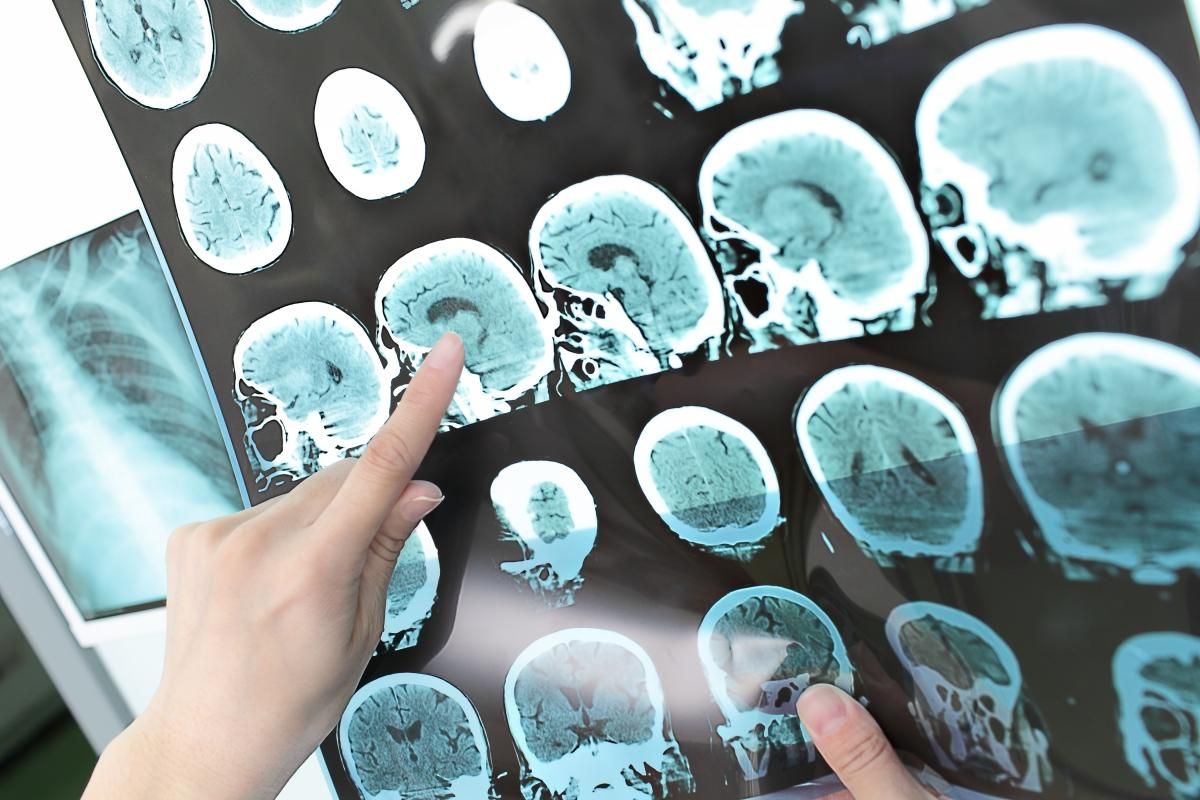 treatment of brain tumors, treatment of brain tumors, treatment of brain tumors in Moscow.