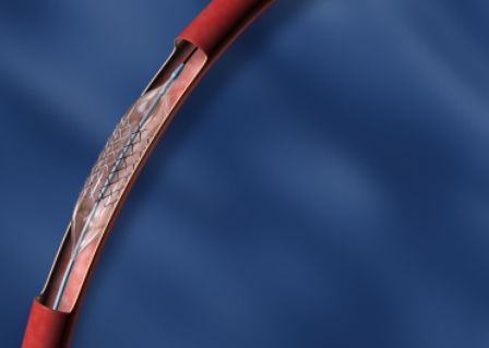 balloon angioplasty