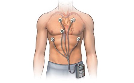 daily ECG monitoring
