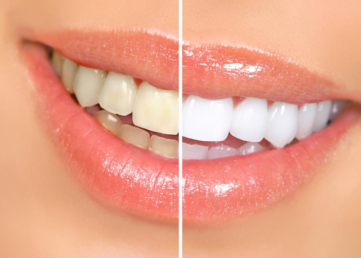 zoom teeth whitening in Moscow