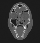 CT scan of the eye socket