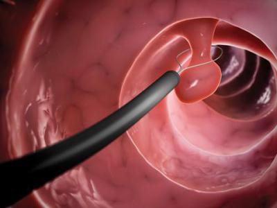 removal of polyps by electrosurgical loop in EMC