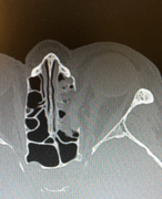 Diagnosis of fracture of the eye socket wall