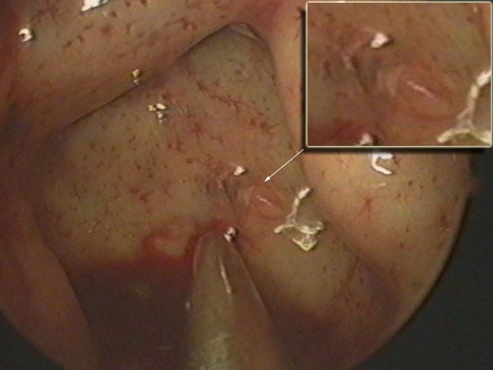 Diagnosis of nasal liquorrhea