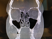 Fracture of the orbital wall