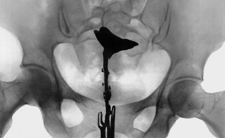 fallopian tube obstruction