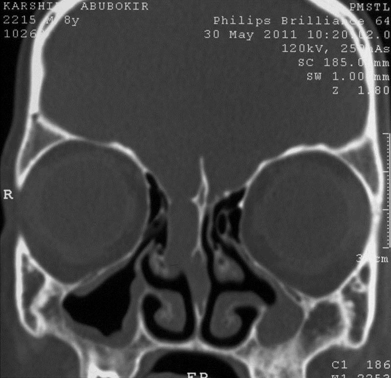 CT scan for nasal liquorrhea