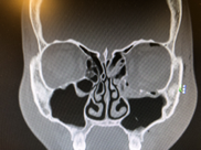 Treatment of fracture of the orbital wall