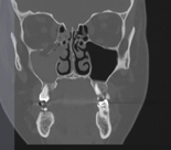 Surgery for fracture of the eye socket wall
