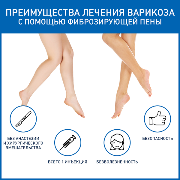 foam sclerotherapy