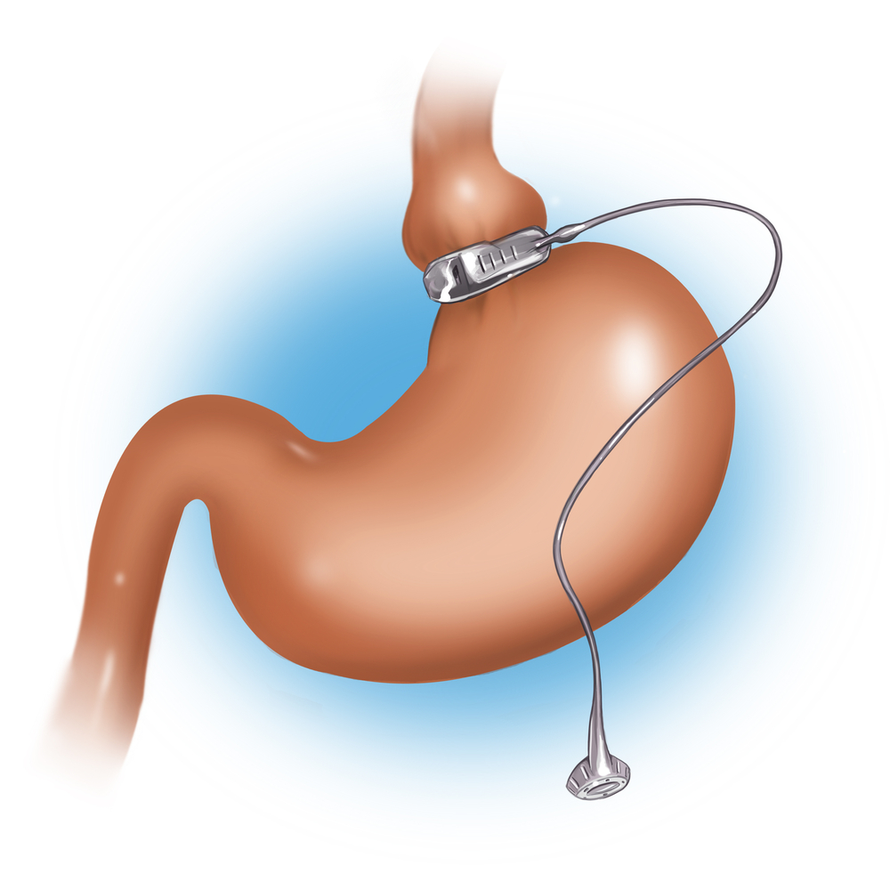 Gastric bandaging in EMC