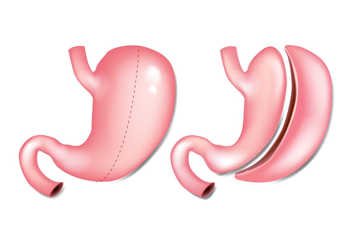 Sleeve gastroplasty in EMC