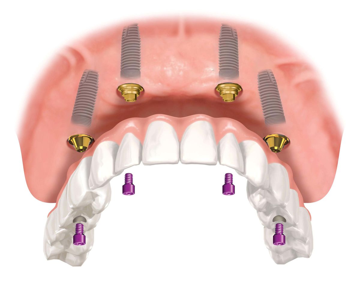 single-stage implantation price