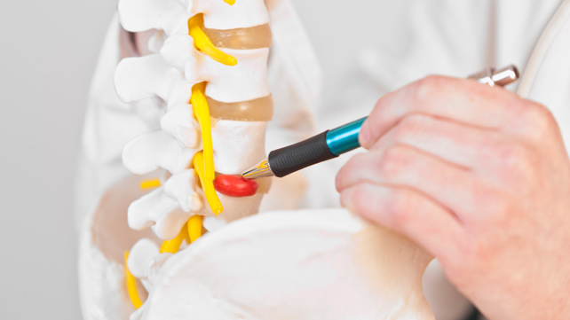 intervertebral hernia treatment