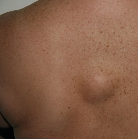 Skin growths